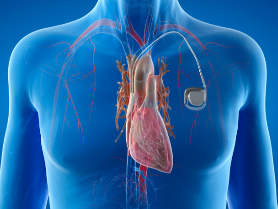 Getting to the heart of the matter: living and loving after a pacemaker
