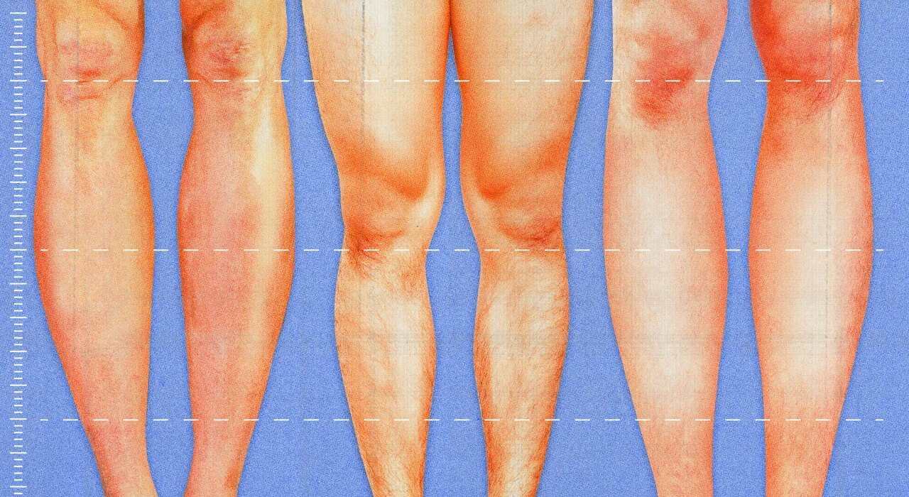 Why leg lengthening surgery may soon become more common?